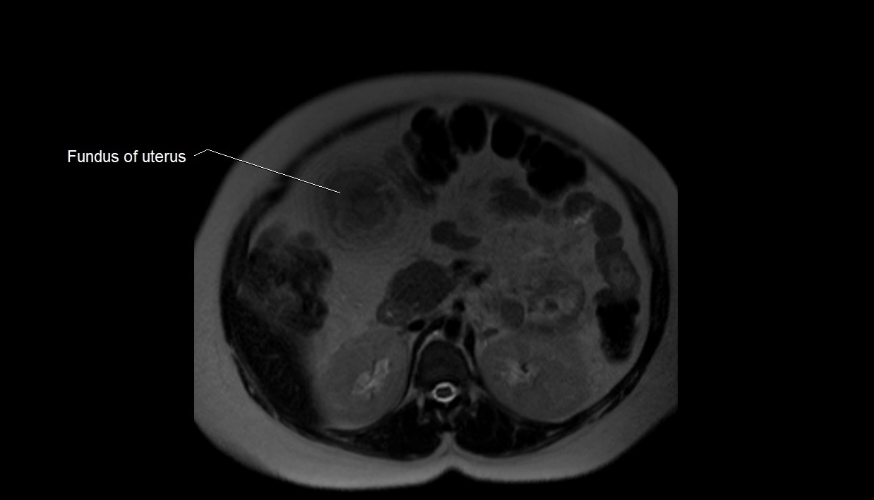 MRI fetal anatomy axial image 1.webp